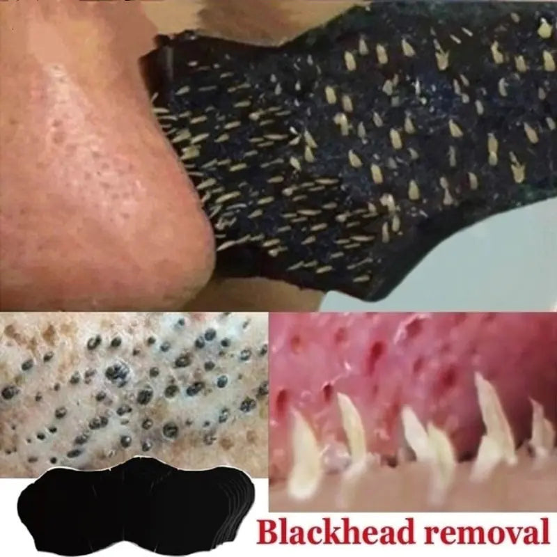 Blackhead removal product with close-up of nose and blackheads, and a blackhead being extracted.